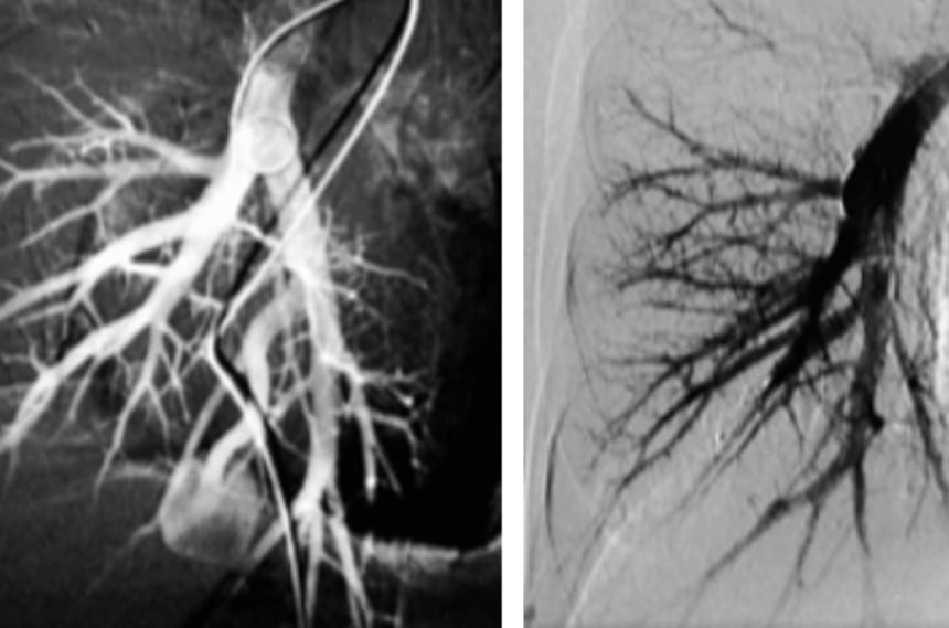 Malformación Arterio-venosa Pulmonar